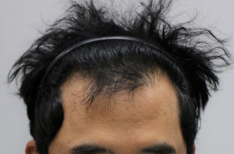 포헤어의원 M자 무삭발 비절개모발이식 7개월 후기