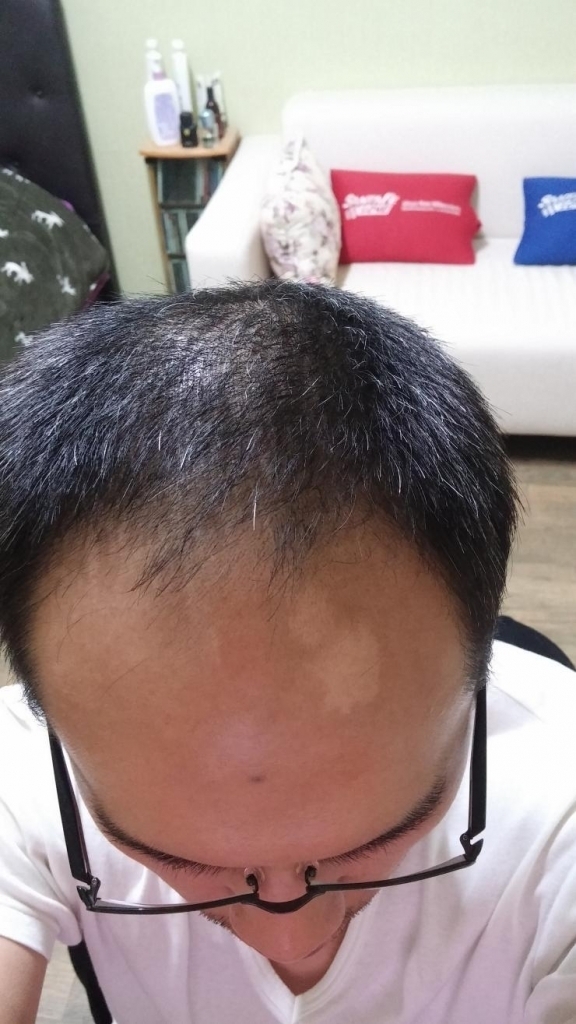 2300모낭 이식 수술 후기입니다.