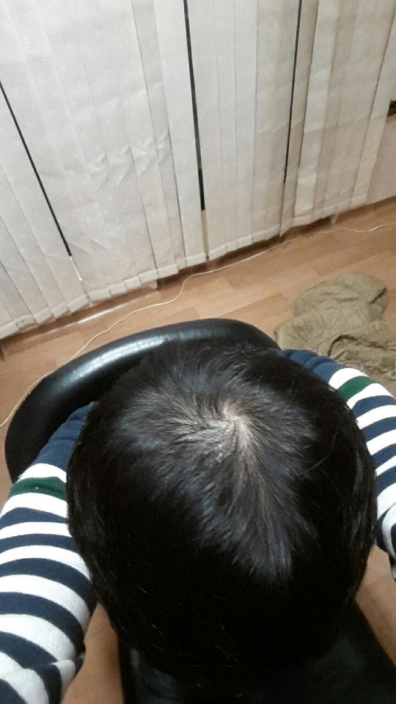 수술전 정수리.jpg