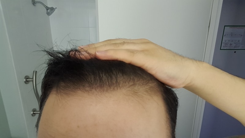 수술50일뒤3.jpg