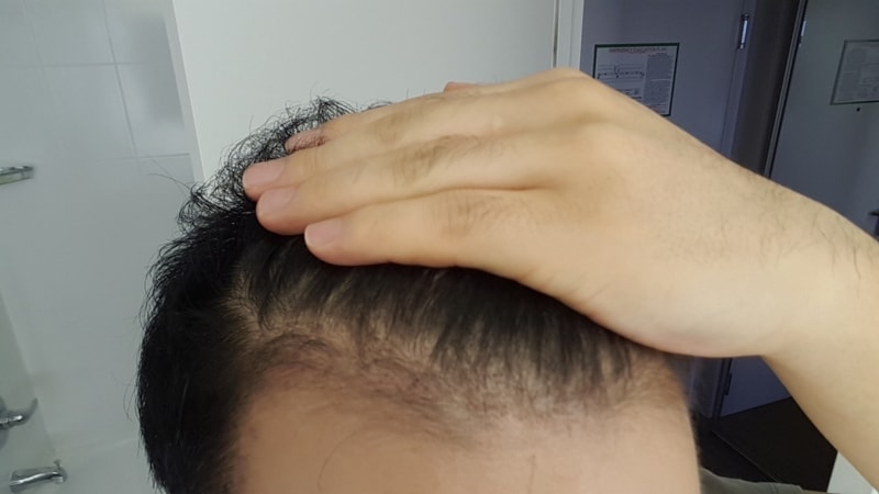 수술50일뒤2.jpg