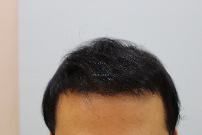 수술열흘뒤1.jpg