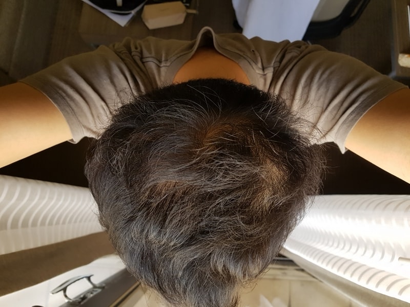 수술50일뒤.jpg