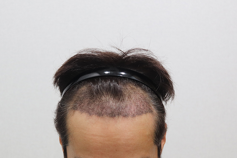 수술2주 경과.jpg