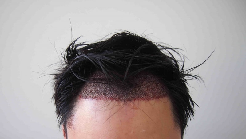 수술후 1.JPG