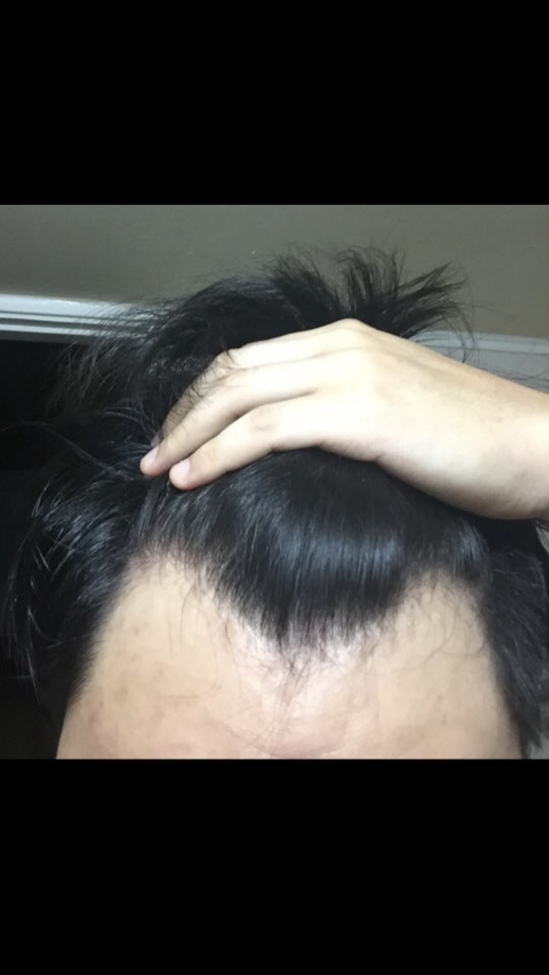 포헤어 수술 1년후기