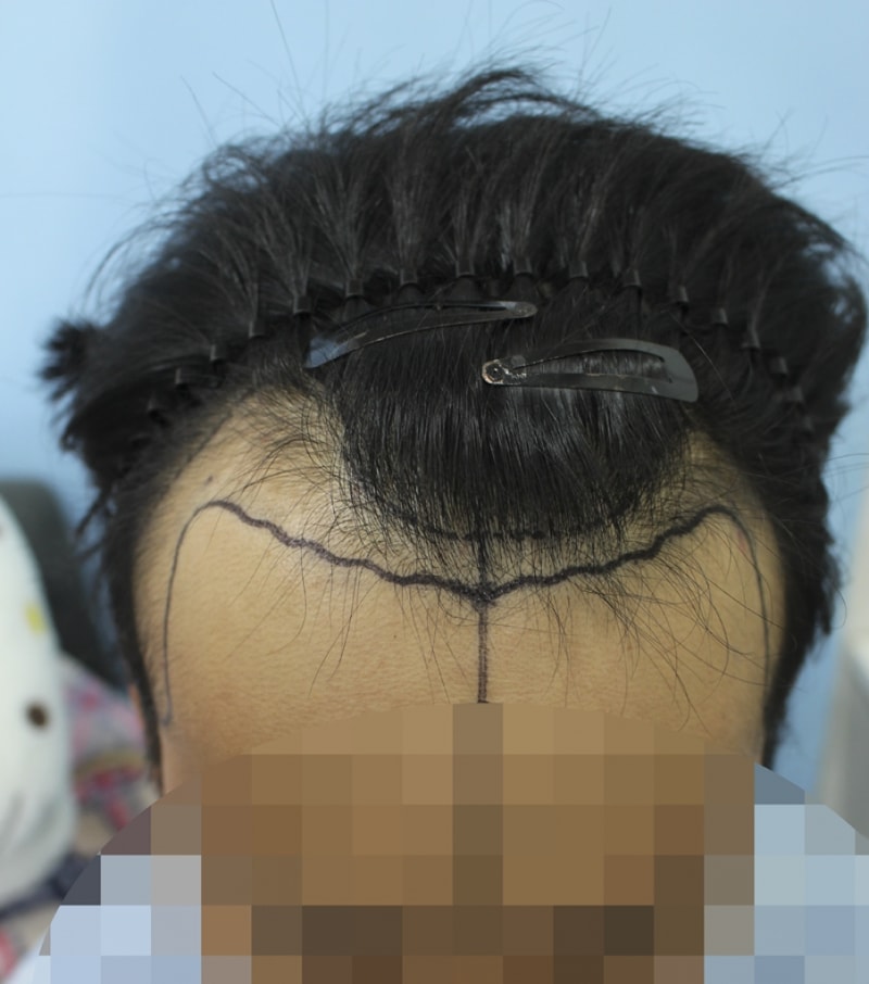 M자+옆선 절개 3000모 4개월 됐습니다