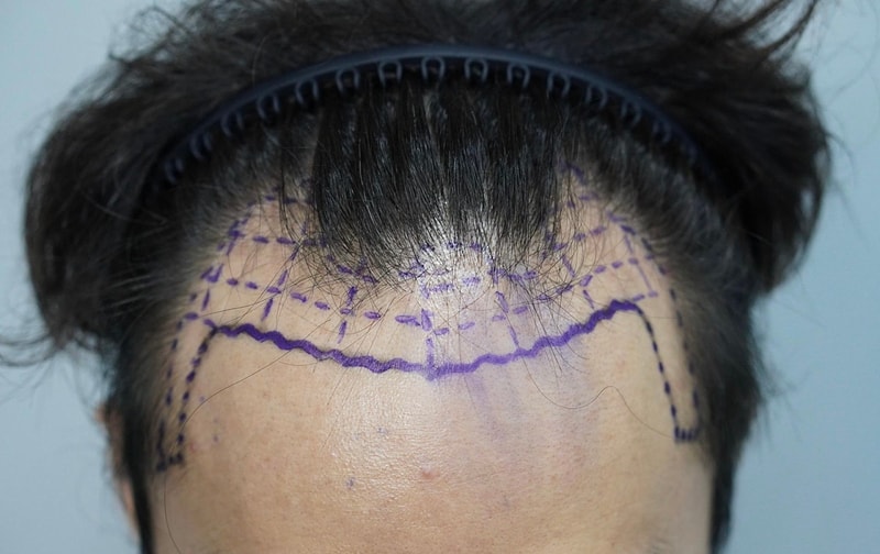 Glow Clinic (formerly New Hair Busan) Hair Transplant Surgery 4,500 hair 10 days later
