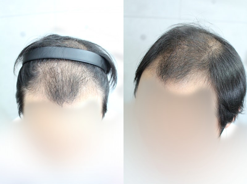 수술전.png