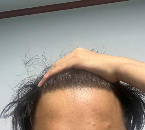 다나성형외과 대량이식 11개월입니다