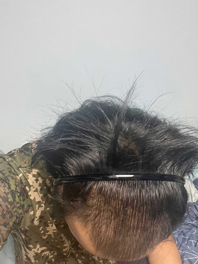 다나성형외과 대량모발이식 6000모 17개월