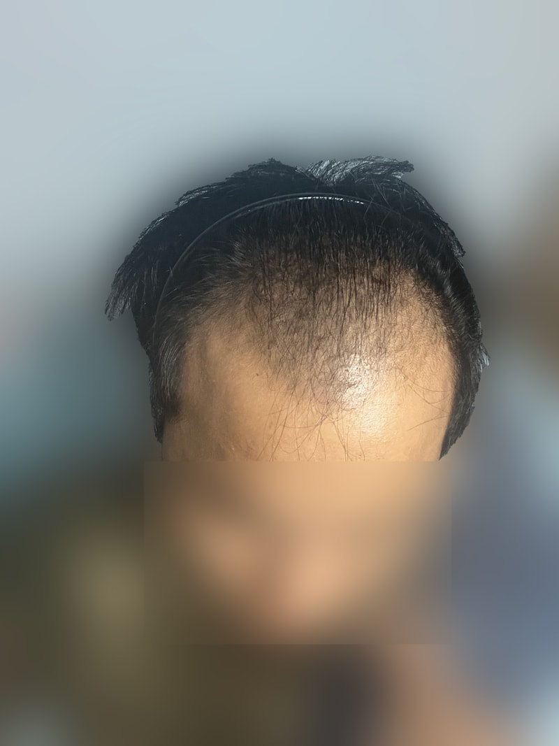 대량이식 전.jpg