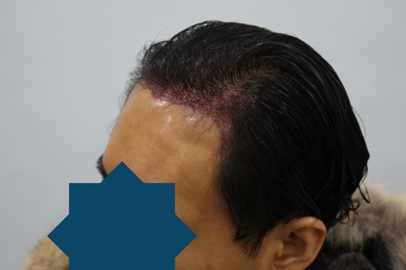 수술후5.jpg