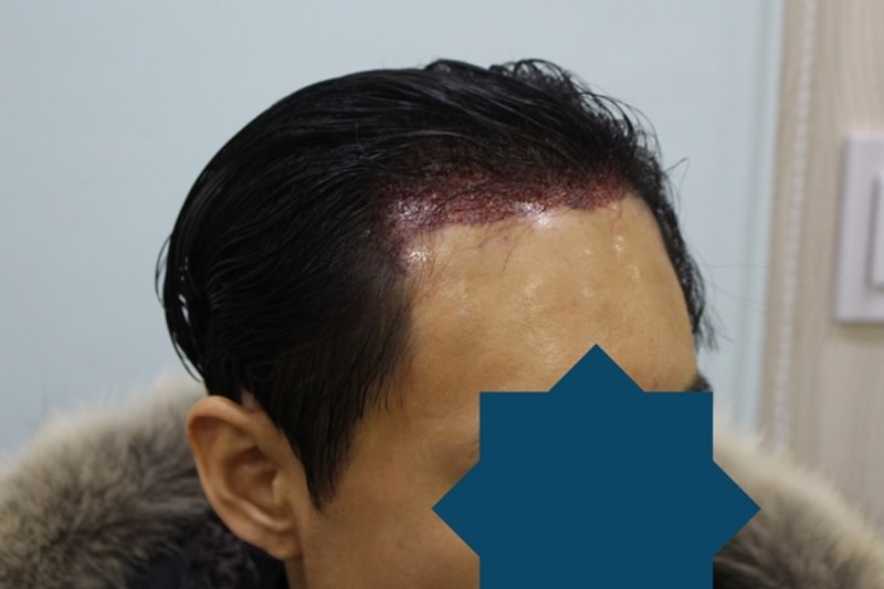 수술후4.jpg