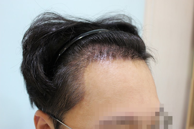 수술후 10일 (7).JPG