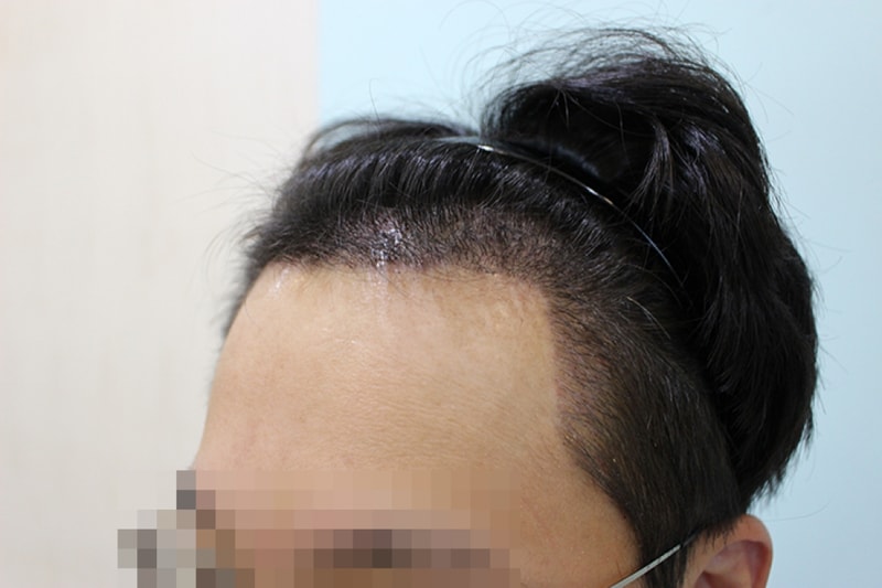 수술후 10일 (5).JPG