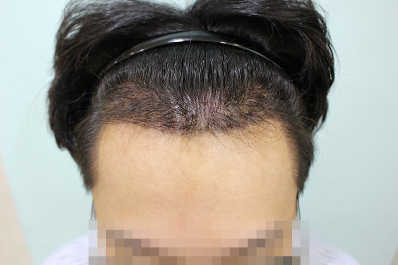 수술후 10일 (4).JPG