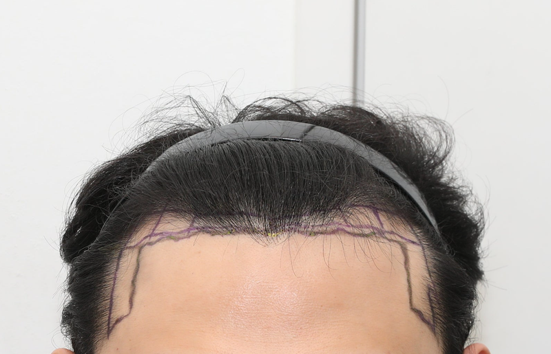 뉴헤어 모발성형외과 모발이식 1900모낭 1년 후기
