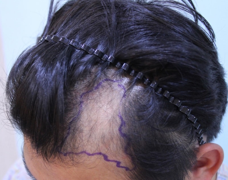 수술전 디자인.jpg