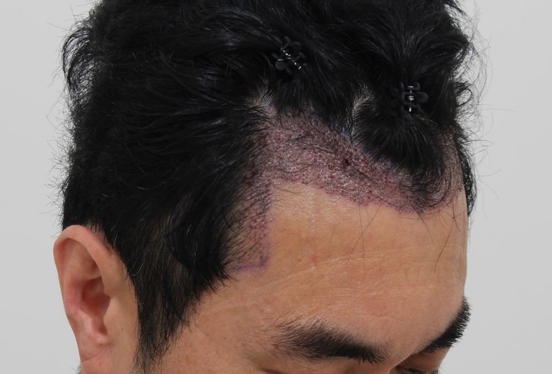 1일차 이식샴푸후 3.JPG