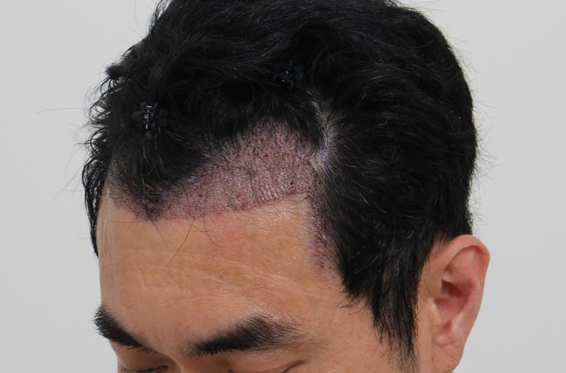 1일차 이식샴푸후 2.JPG