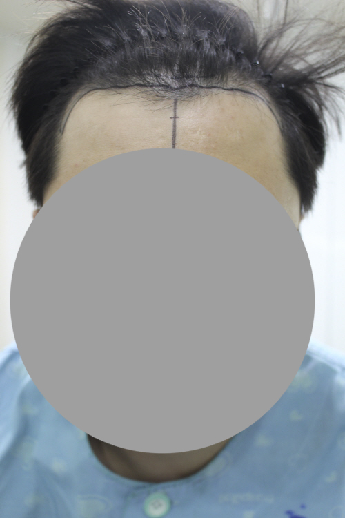 M+구레나룻해서 3200모 한나이브에서 했습니다