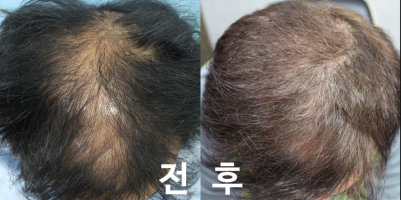한나이브 정수리 절개 4600모+@ 후기글 남겨드립니다