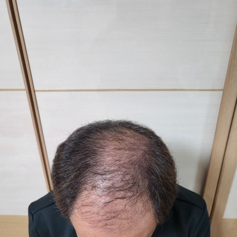 Dana 5000 hair follicle non-cut mass hair transplantation for 3 months