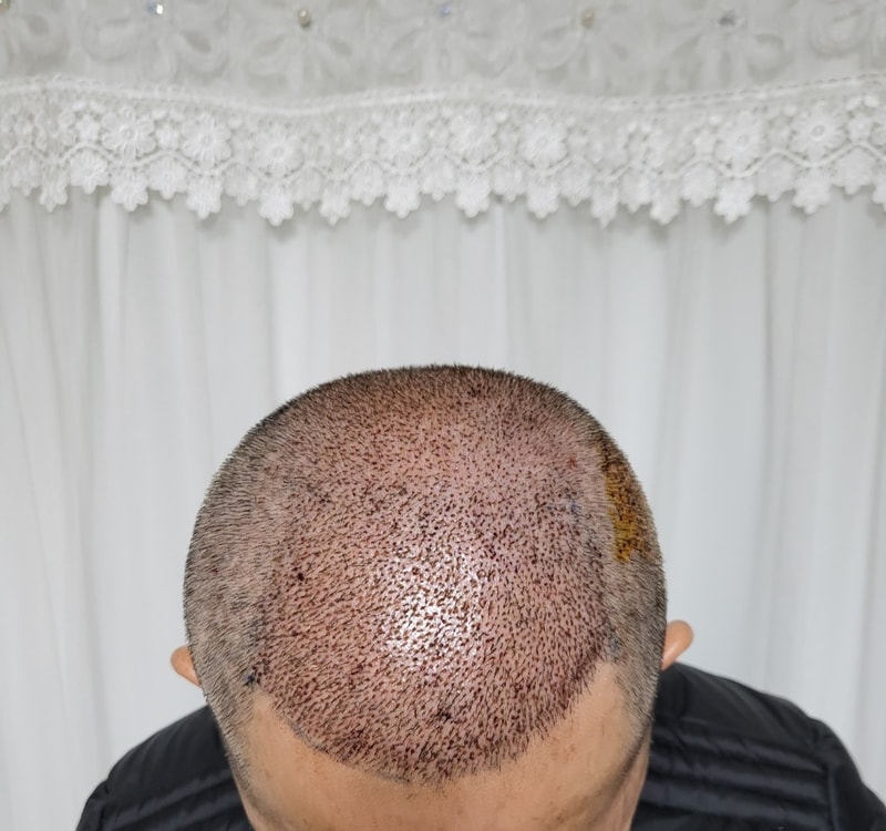 Dana Plastic Surgery Department 5000 Hair follicle transplantation 1 month check