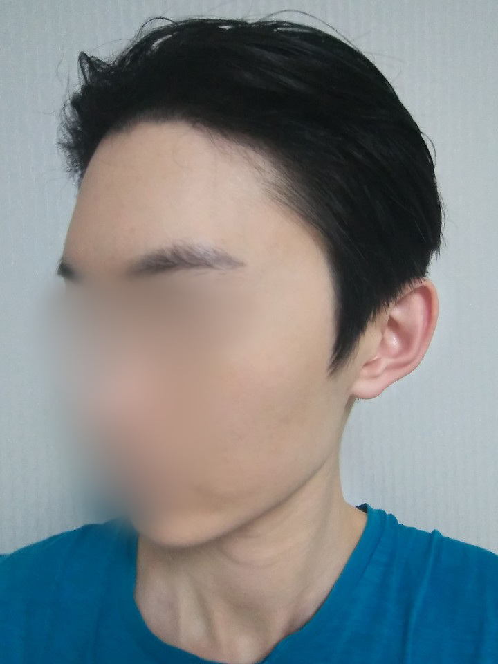 03.김재환_수술6달.jpg