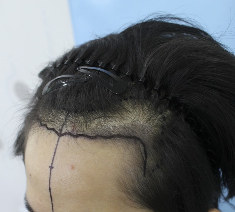 안 희준_20161124_모발_60762.png