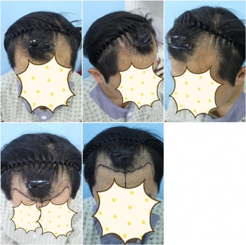 절개 3600모 엠자 후기입니다