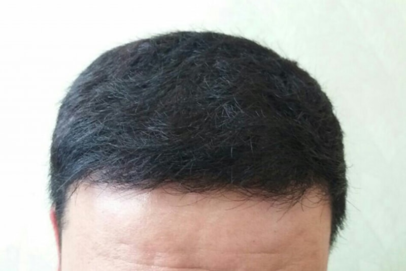 수술후.jpg