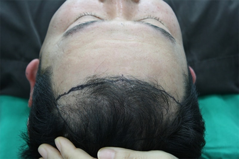 수술전.jpg