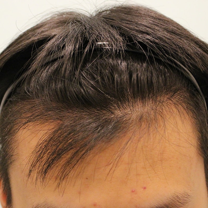 수술후 3개월 (7).JPG