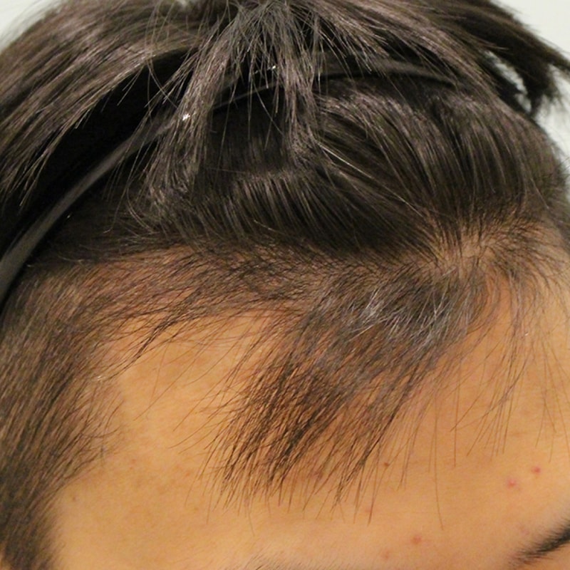 수술후 3개월 (3).JPG