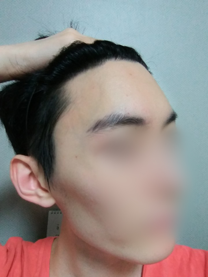 03.김재환_수술10달.jpg