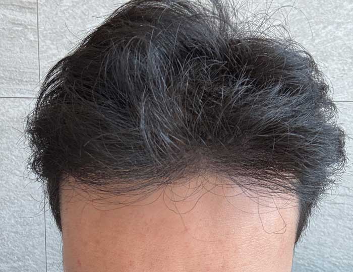 다나성형외과 비절개모발이식 20개월입니다 ㅎ