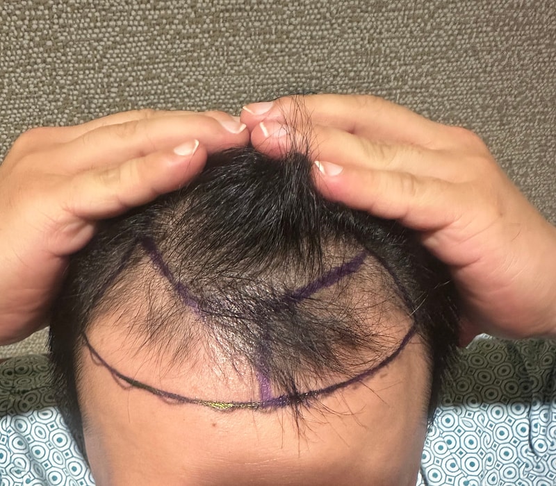ニューヘアー 植毛切開 2000株3ヵ月目