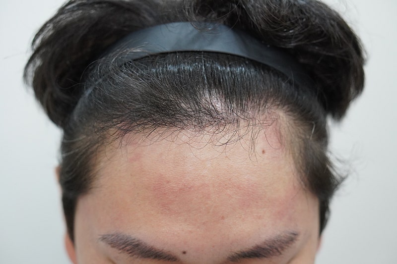 그로우의원(구 뉴헤어부산)  비절개 모발이식 2000모 6개월차 후기