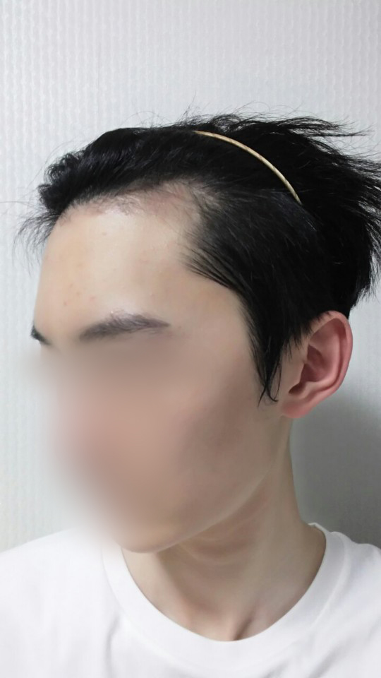 05.수술 두달1.jpg