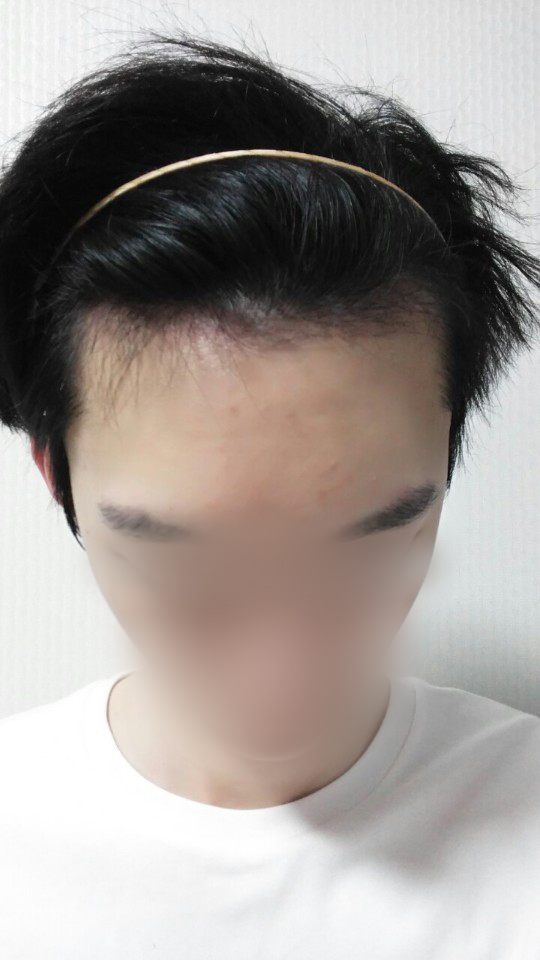05.수술 두달5.jpg