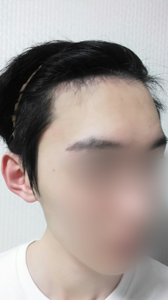05.수술 두달3.jpg