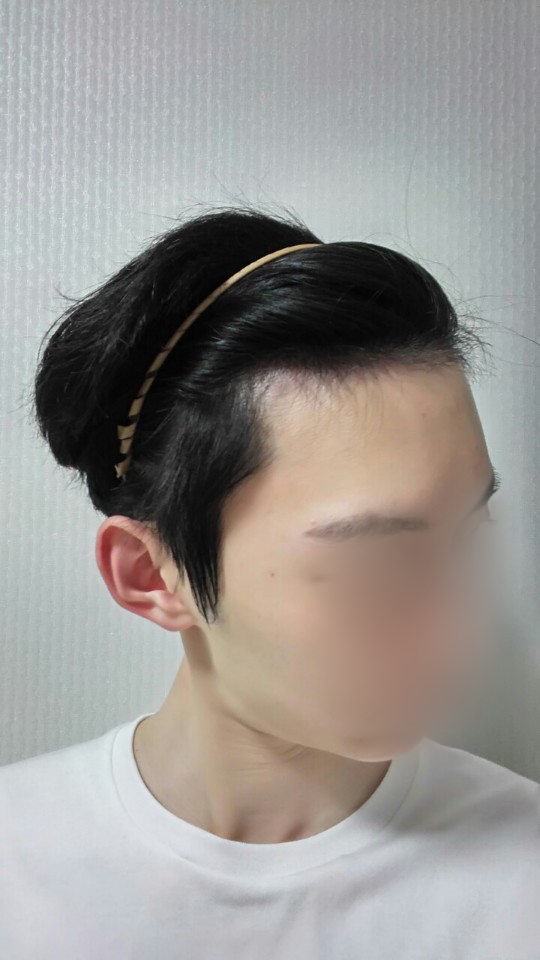 05.수술 두달2.jpg