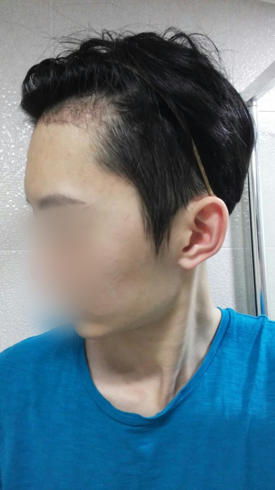 04.수술 한달3.jpg
