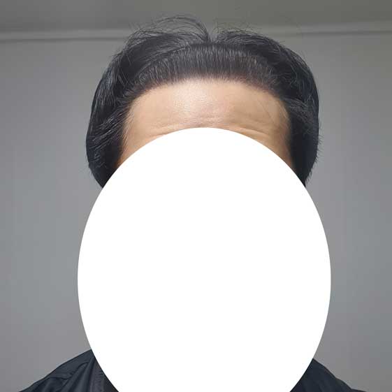 다나성형외과 무삭발모발이식 11개월