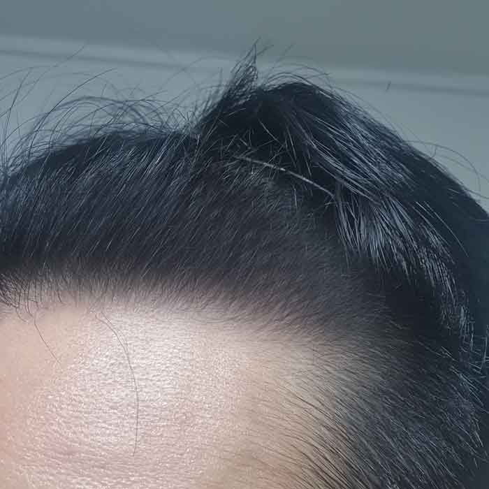 다나성형외과 무삭발비절개 9개월