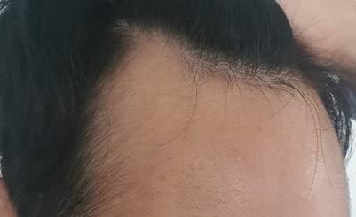 수술전ㅠㅠ.jpg