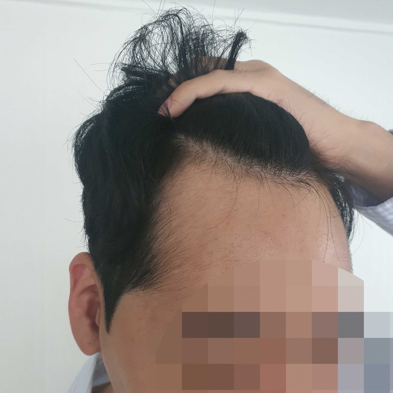 수술전뾰족이마어쩌냐.jpg