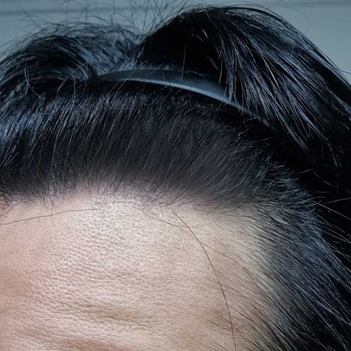 다나성형외과 무삭발 비절개모발이식 1년차